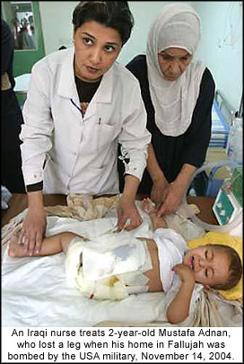 An Iraqi nurse treats 2-year-old Mustafa Adnan, who lost a leg when his home in Fallujah was bombed by the USA military, November 14, 2004.